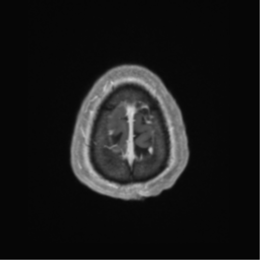 Basal ganglia metastasis (Radiopaedia 78928-91828 Axial T1 C+ 71).png