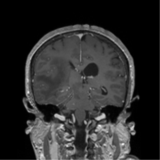 Basal ganglia metastasis (Radiopaedia 78928-91828 Coronal T1 C+ 6).png