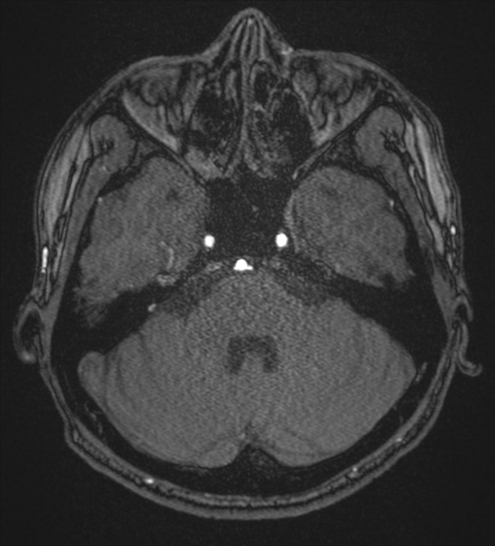 Basal ganglia subacute infarct (Radiopaedia 80201-93521 Axial MRA 20).png