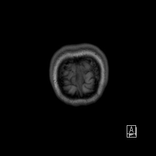 Base of skull rhabdomyosarcoma (Radiopaedia 32196-33142 Coronal T1 55).jpg
