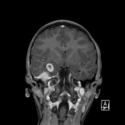 Base of skull rhabdomyosarcoma (Radiopaedia 32196-33142 I 37).jpg