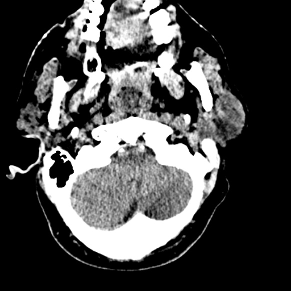 Basilar artery thrombosis (Radiopaedia 53351-59333 Axial non-contrast 23).jpg
