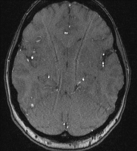 Basilar tip aneurysm (Radiopaedia 26504-26632 MRA 98).jpg