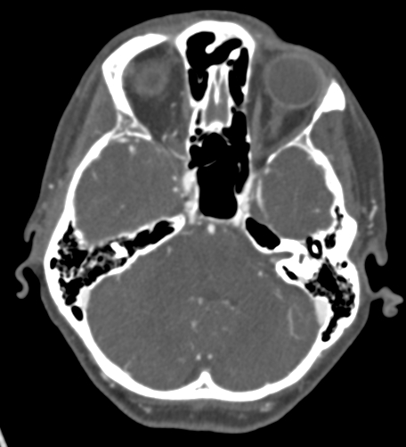 Basilar tip aneurysm with coiling (Radiopaedia 53912-60086 A 43).jpg