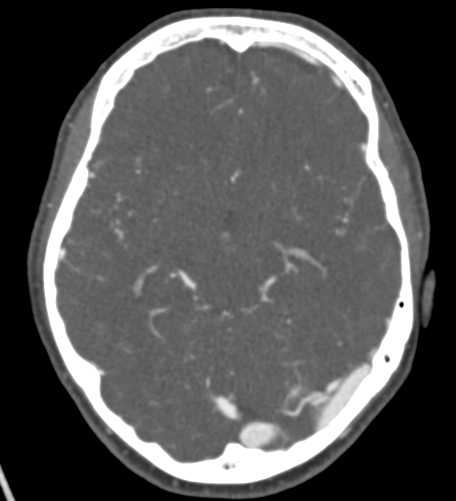 File:Basilar tip aneurysm with coiling (Radiopaedia 53912-60086 A 66).jpg