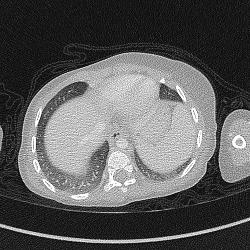 Beckwith-Wiedeman syndrome with bilateral Wilms tumors (Radiopaedia 60850-68629 Axial lung window 49).jpg
