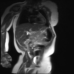 File:Beckwith-Wiedeman syndrome with bilateral Wilms tumors (Radiopaedia 60850-69233 B 17).jpg