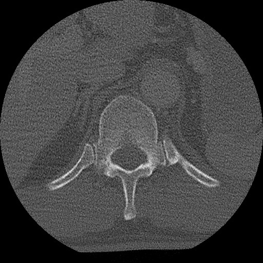 Benign post-traumatic pseudopneumoperitoneum (Radiopaedia 71199-81495 Axial bone window 165).jpg