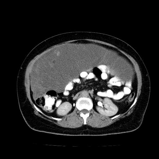 Benign spindle cell tumor - abdominopelvic (Radiopaedia 61300-69212 Axial C+ delayed 26).jpg