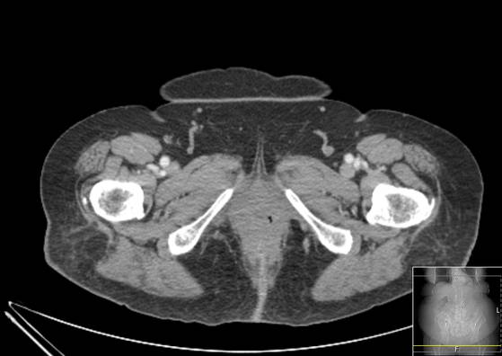 Bicameral celiacomesenteric aneurysm (Radiopaedia 55766-62327 A 79).jpg