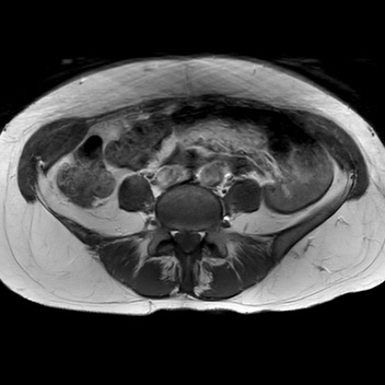 File:Bicornuate uterus (Radiopaedia 61974-70046 Axial T1 11).jpg