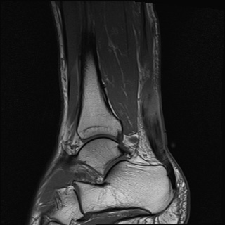 File:Bilateral Achilles tendon complete tear (Radiopaedia 81344-95051 Sagittal T1 7).jpg