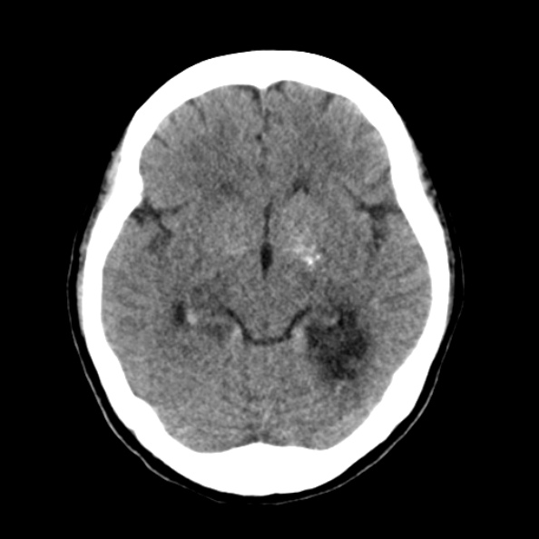 File:Bilateral PCA territory infarction - different ages (Radiopaedia 46200-50591 Axial non-contrast 9).jpg