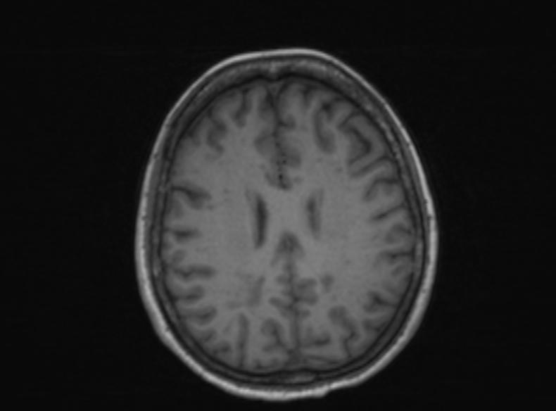 Bilateral PCA territory infarction - different ages (Radiopaedia 46200-51784 Axial T1 196).jpg