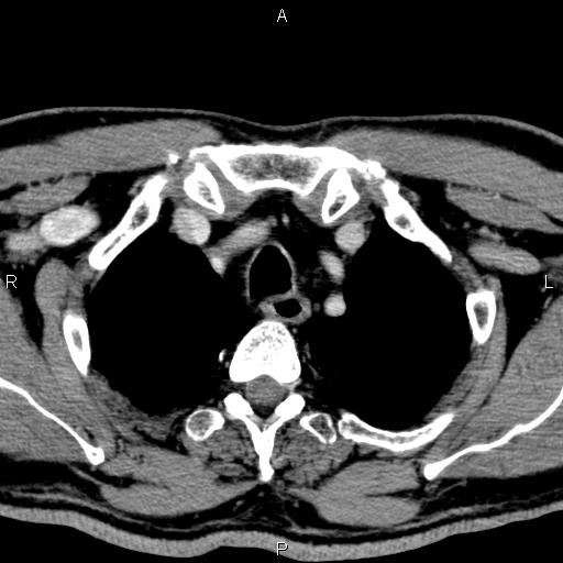 Bilateral Warthin tumors (Radiopaedia 84034-99263 Axial With contrast 68).jpg
