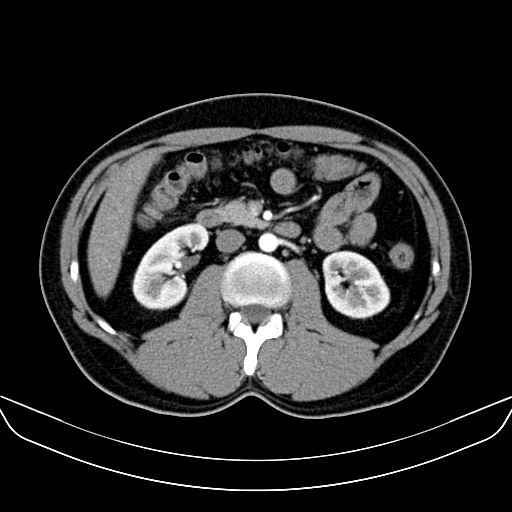 Bilateral accessory renal arteries with mild pelvi-ureteric junction (PUJ) obstruction (Radiopaedia 66357-75596 A 26).jpg