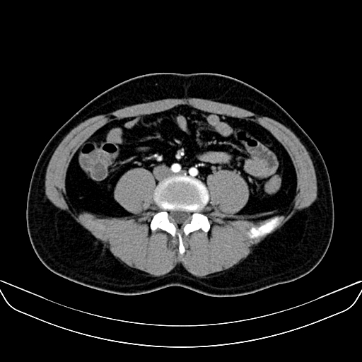 Bilateral accessory renal arteries with mild pelvi-ureteric junction (PUJ) obstruction (Radiopaedia 66357-75596 A 41).jpg