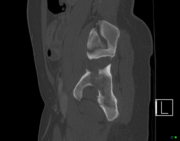 Bilateral acetabular fractures (Radiopaedia 79272-92308 Sagittal bone window 63).jpg