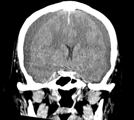 Bilateral acute on chronic subdural hematomas (Radiopaedia 78466-91146 Coronal non-contrast 32).jpg
