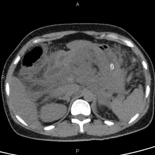 Bilateral adrenal gland hyperenhancement in pancreatitis (Radiopaedia 86642-102753 Axial non-contrast 32).jpg