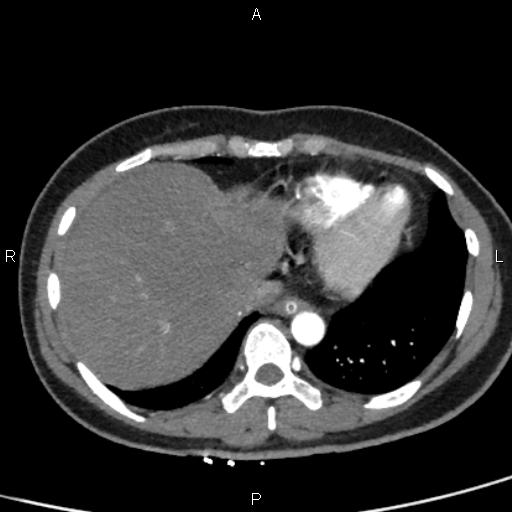 Bilateral adrenal gland hyperenhancement in pancreatitis (Radiopaedia 86642-102753 B 11).jpg