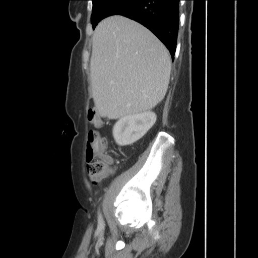 File:Bilateral adrenal granulocytic sarcomas (chloromas) (Radiopaedia 78375-91007 C 43).jpg