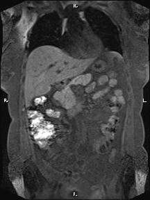 Bilateral adrenal myelolipoma (Radiopaedia 63058-71537 Coronal T1 fat sat 68).jpg