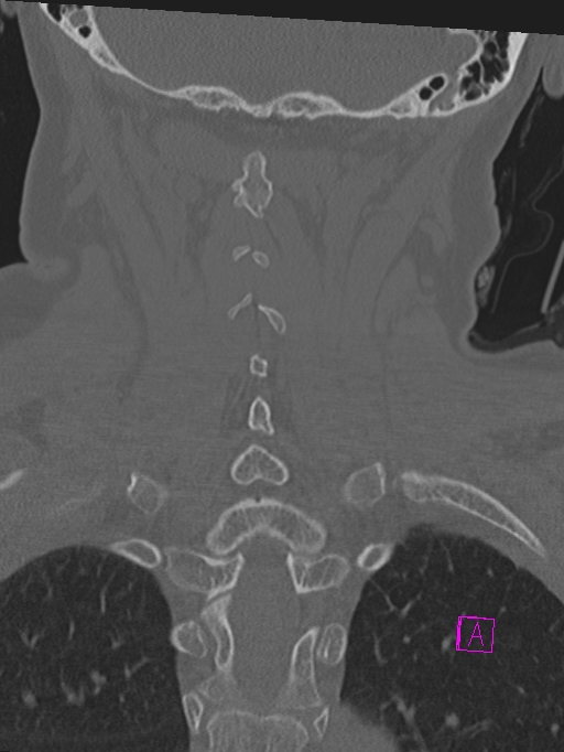 Bilateral atlanto-occipital assimilation (Radiopaedia 28350-28603 Coronal bone window 35).jpg