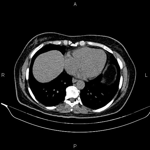 Bilateral benign adrenal adenomas (Radiopaedia 86912-103124 Axial non-contrast 12).jpg