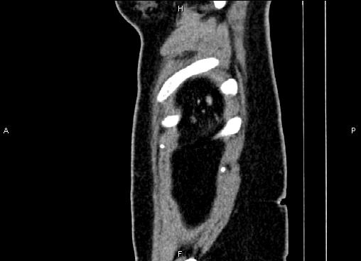 Bilateral benign adrenal adenomas (Radiopaedia 86912-103124 E 96).jpg