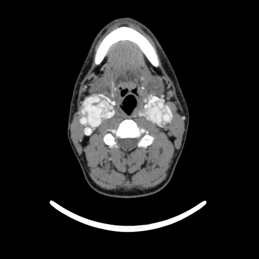 Bilateral carotid body tumors (Radiopaedia 52899-58827 A 11).jpg