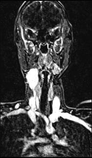 File:Bilateral carotid body tumors and right glomus jugulare tumor (Radiopaedia 20024-20060 MRA 88).jpg