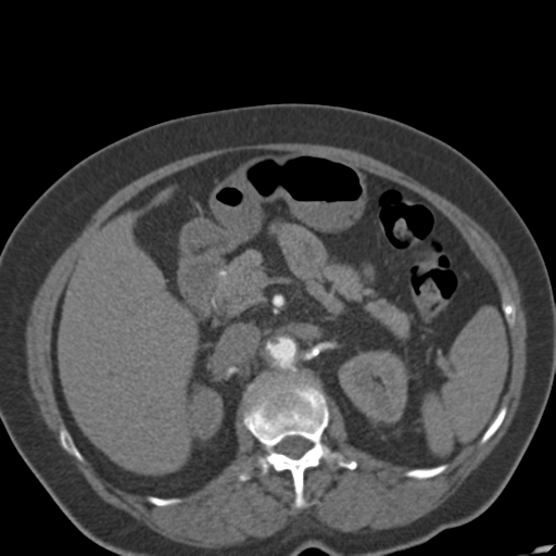 File:Bilateral delayed nephrogram from renal artery stenosis (Radiopaedia 47681-52362 A 21).png