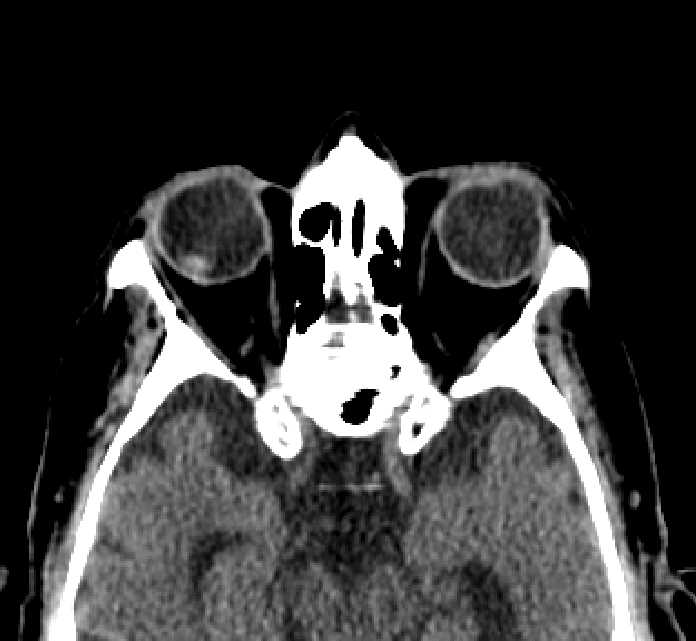 Bilateral ectopia lentis (Radiopaedia 89889-107013 Axial non-contrast 35).jpg