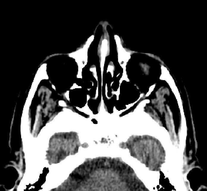 Bilateral ectopia lentis (Radiopaedia 89889-107013 Axial non-contrast 72).jpg