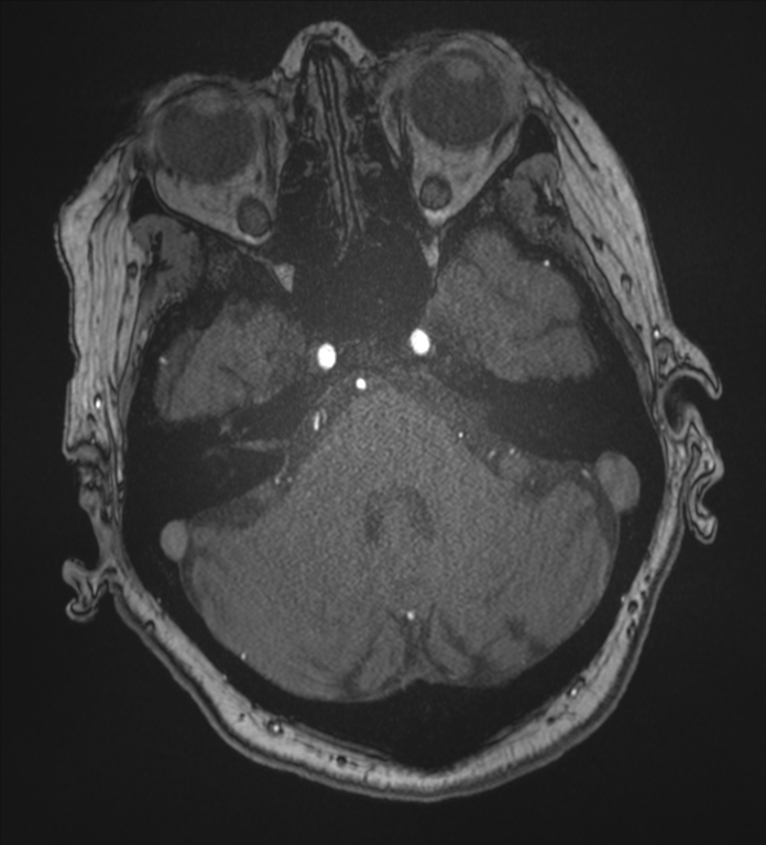 Bilateral fetal posterior communicating arteries (Radiopaedia 41286-44102 Axial MRA 45).png