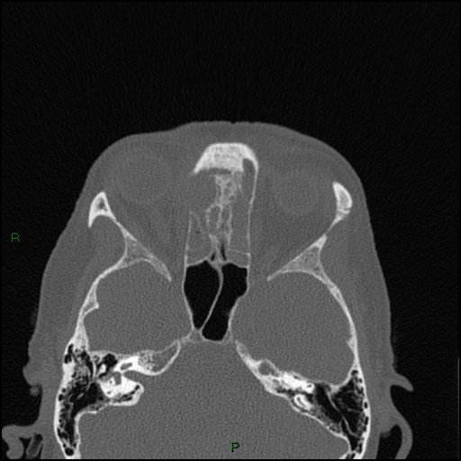 Bilateral frontal mucoceles (Radiopaedia 82352-96454 Axial bone window 136).jpg