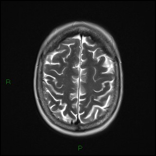 File:Bilateral frontal mucoceles (Radiopaedia 82352-96455 Axial T2 17).jpg