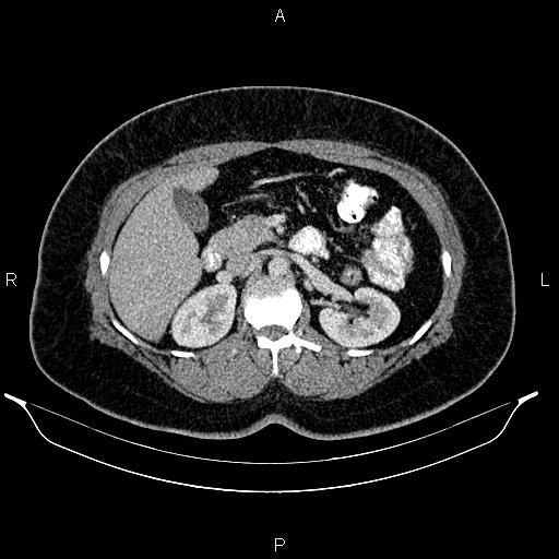 Bilateral ovarian dermoid cysts (Radiopaedia 85785-101603 A 42).jpg