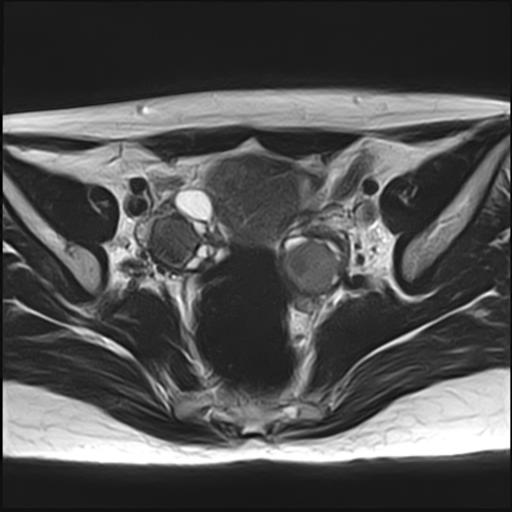 File:Bilateral ovarian endometriomas (Radiopaedia 87085-103347 Axial T2 9).jpg