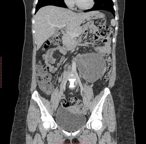 File:Bilateral ovarian serous cystadenocarcinoma with right ovarian torsion (Radiopaedia 32640-33611 B 17).jpg