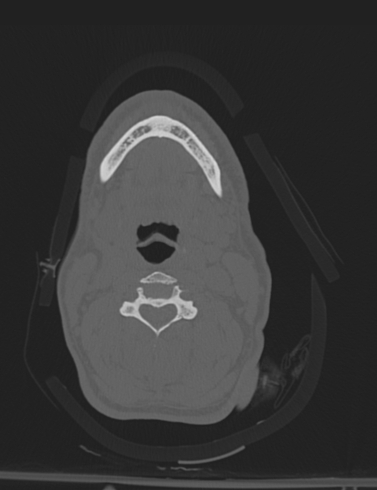 File:Bilateral perched facet joint (Radiopaedia 63149-71669 Axial bone window 25).jpg