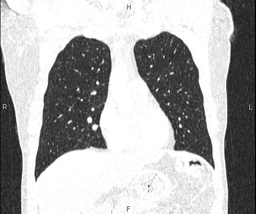 Bilateral pulmonary AVM (Radiopaedia 83134-97505 Coronal lung window 32).jpg
