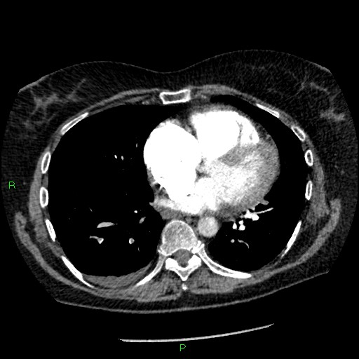 Bilateral pulmonary emboli (Radiopaedia 32700-33669 Axial C+ CTPA 69).jpg