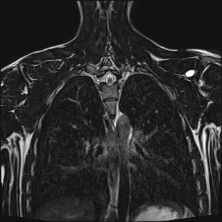File:Bilateral spinoglenoid notch ganglion cysts (Radiopaedia 29577-30082 Coronal T2 88).jpg