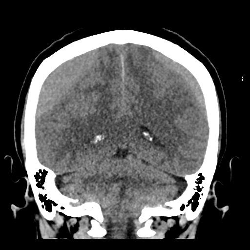 File:Bilateral subacute subdural hematoma (Radiopaedia 69240-79018 Coronal non-contrast 39).jpg