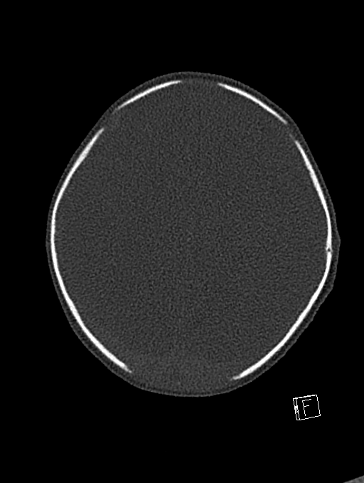 Bilateral subdural hemorrhage and parietal skull fracture (Radiopaedia 26058-26192 Axial bone window 33).png