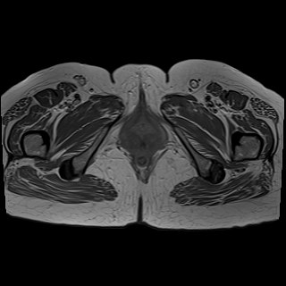 Bilateral tubo-ovarian abscesses (Radiopaedia 58635-65829 Axial T1 C+ 50).jpg