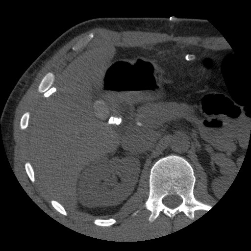 File:Bile leak from liver traumatic laceration (Radiopaedia 63463-72077 Axial Biliscopin 48).jpg