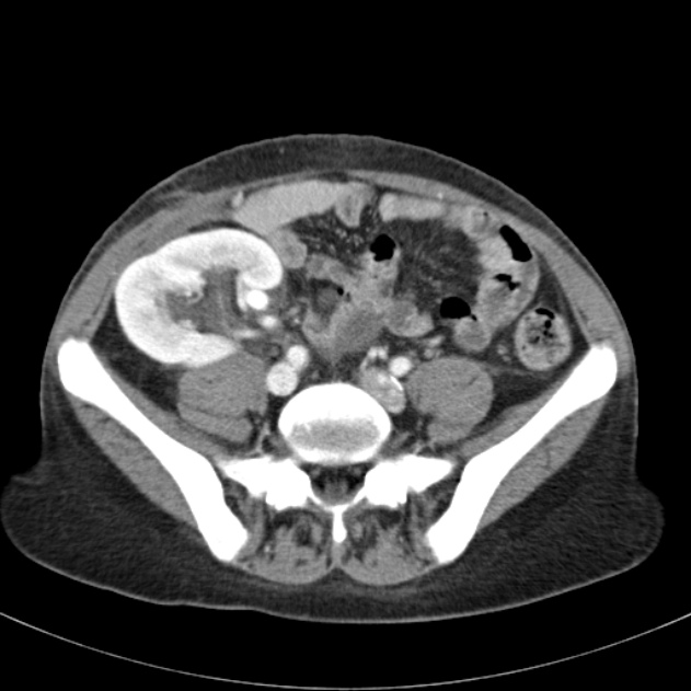 Biliary necrosis - liver transplant (Radiopaedia 21876-21846 B 55).jpg